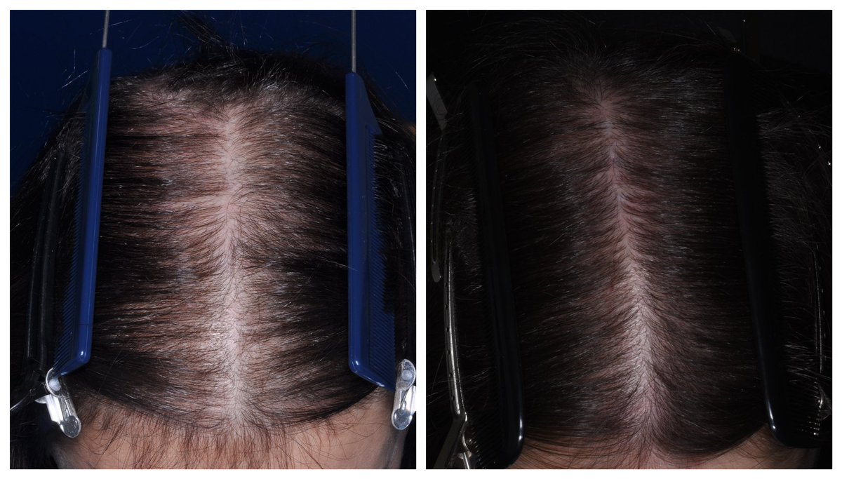 35 year old woman with significant #hair regrowth after 2 years of #treatment with #minoxidil #spironolactone and #bicalutamide for #female pattern #hairloss. Thrilling to see we can make a difference for sufferers of androgenetic #alopecia 
#dermatology #dermtwitter #MedStudents