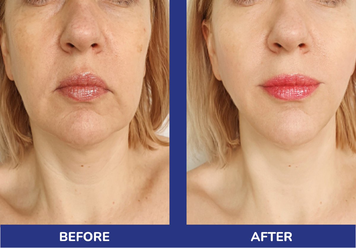 SereneAmanda's tweet photo. The Silhouette Soft is a highly effective thread lift that can be used to correct and tighten the midface, jawline, eyebrow and neck. The results are amazing. 

Contact Amanda today to book your consultation:-
☎️ Phone/message: 07444938248
💻 https://t.co/qvCVh60Ntu https://t.co/T8YKZ8qVkT