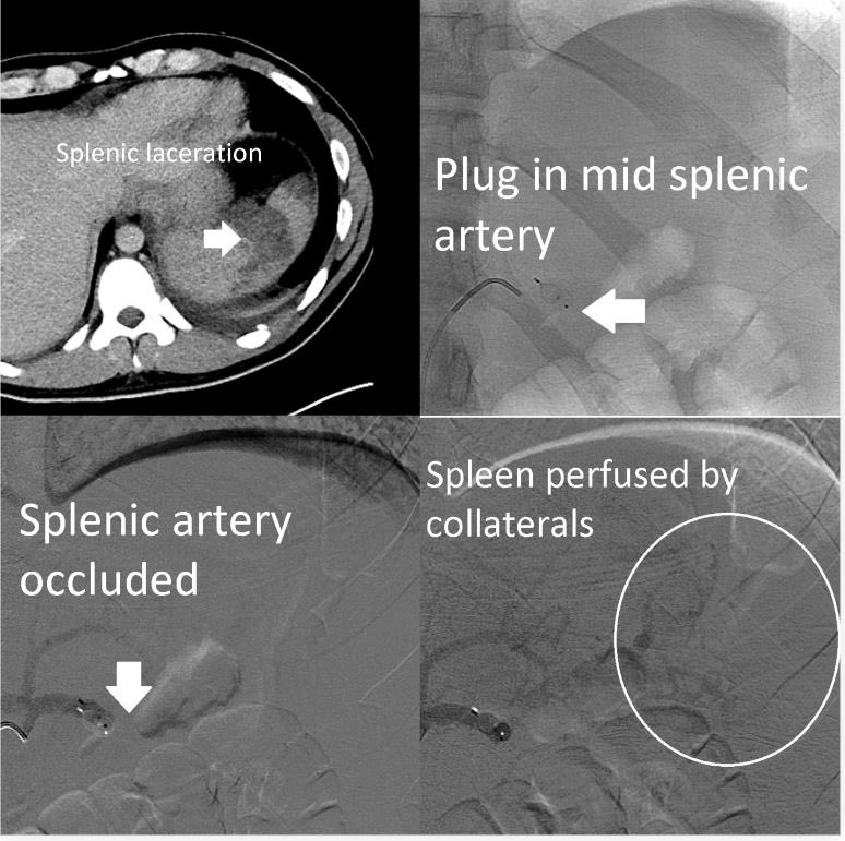 Grade IV splenic laceration in a hemodynamically-stable patient referred to international radiology for splenic artery embolization. This #IRad procedure reduces the pressure on the injured spleen, preserves flow via collateral vessels, &amp; improves splenic salvage in #trauma.