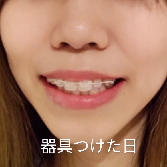 ERIkyosei's tweet photo. 比較！正面からの印象もだいぶ変化出てきた気がする。スマイルラインの上が真っ直ぐになった（前はどら焼き型、、）あと鼻の穴が見えにくくなった気がする😂
老けた感は否めない、、！この余った頬肉のたるみ？どうしたらいいんや？ https://t.co/yOuMopwkml