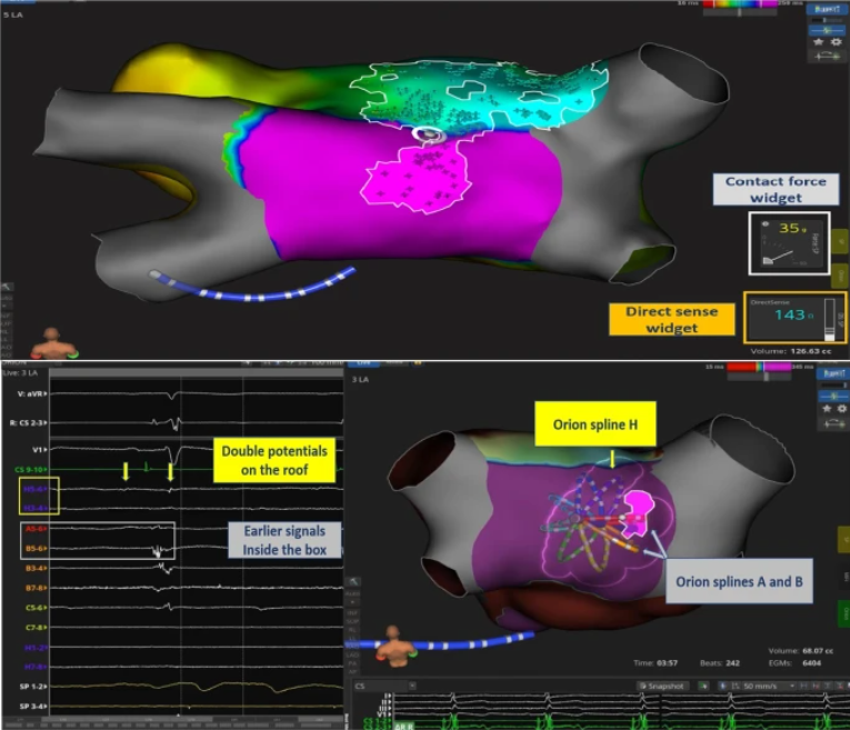 BSC_EU_Heart's tweet photo. In 93% of patients, successful left atrial posterior wall isolation is achieved by local impedance drop guidance.
Learn from Solimene, et al. how to benefit from #DIRECTSENSE for effective and safe endocardial ablation: https://t.co/hJu54WKMbu
#BSCEMEA https://t.co/SWeqsVtBqj