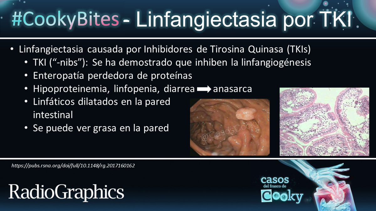 CasosCooky's tweet photo. Respuesta: Linfangiectasia por Inhibidores de Tirosina Quinasa (TKIs)
Aprende más: https://t.co/vGmZaJQsrw
Traducido por: @FcalleMD #CasosCooky #CookyBites #3 #RGphx @cookyscan1 @RadioGraphics https://t.co/C8CcGxtzDq