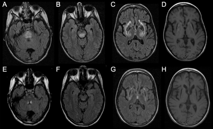 MDCP_Journal's tweet photo. Does MRI help to select pediatric patients with neurologic Wilson Disease for liver transplantation? @catmendespinto @MariaJooMalaqu1 https://t.co/Z5MiSKOiZk https://t.co/5PvYx6Rdlq
