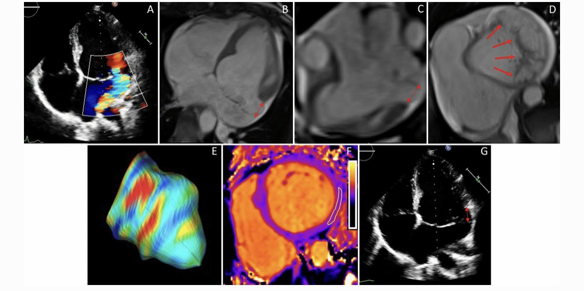 Christina Tiller (@ct_tiller) on Twitter photo Interesting Case Report about a young female patient with mitral annular disjunction <a href="/ReinstadlerSJ/">Sebastian J Reinstadler</a>
Check it out <a href="/IntJCVImaging/">International Journal of Cardiovascular Imaging</a> link.springer.com/article/10.100… Interesting Case Report about a young female patient with mitral annular disjunction <a href="/ReinstadlerSJ/">Sebastian J Reinstadler</a>
Check it out <a href="/IntJCVImaging/">International Journal of Cardiovascular Imaging</a> link.springer.com/article/10.100…