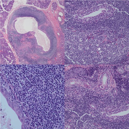 Triological's tweet photo. Superficial Parotidectomy for Juvenile Recurrent Parotitis. Read about long-term outcomes, imaging, and pathologic findings in this free article: https://t.co/izyQgVkb6J. #Laryngoscope #Parotitis #ENTSurgery https://t.co/YeFJp306rA