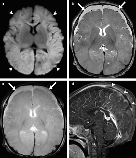 MirskyDavid's tweet photo. Hot off the press!

Prevalence of cerebral sinovenous thrombosis in abusive head trauma

https://t.co/w6Yt9o7IbZ https://t.co/jN5wpEZKNg