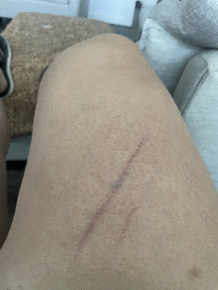 D_BSC09's tweet photo. When the dog jumps on you and you bruise like a peach. #instantlybruised #damndog #ouch https://t.co/V85LgodNon
