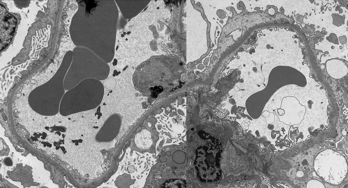 AKI and nephrotic syndrome post COVID infection. Mostly normal glomeruli but rare thrombi. EM showed diffuse podocyte FPE. C/w diffuse podocytopathy/minimal change disease + focal TMA. Also +Anti-phospholipid antibodies. #renalpath #pathtwitter