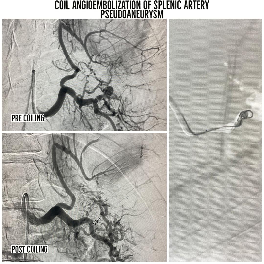 RadJodhpur's tweet photo. #TraumaInterventions #PseudoaneurysmCoiling #CIRSE #SIR #IRAD https://t.co/A1WRuyvteZ
