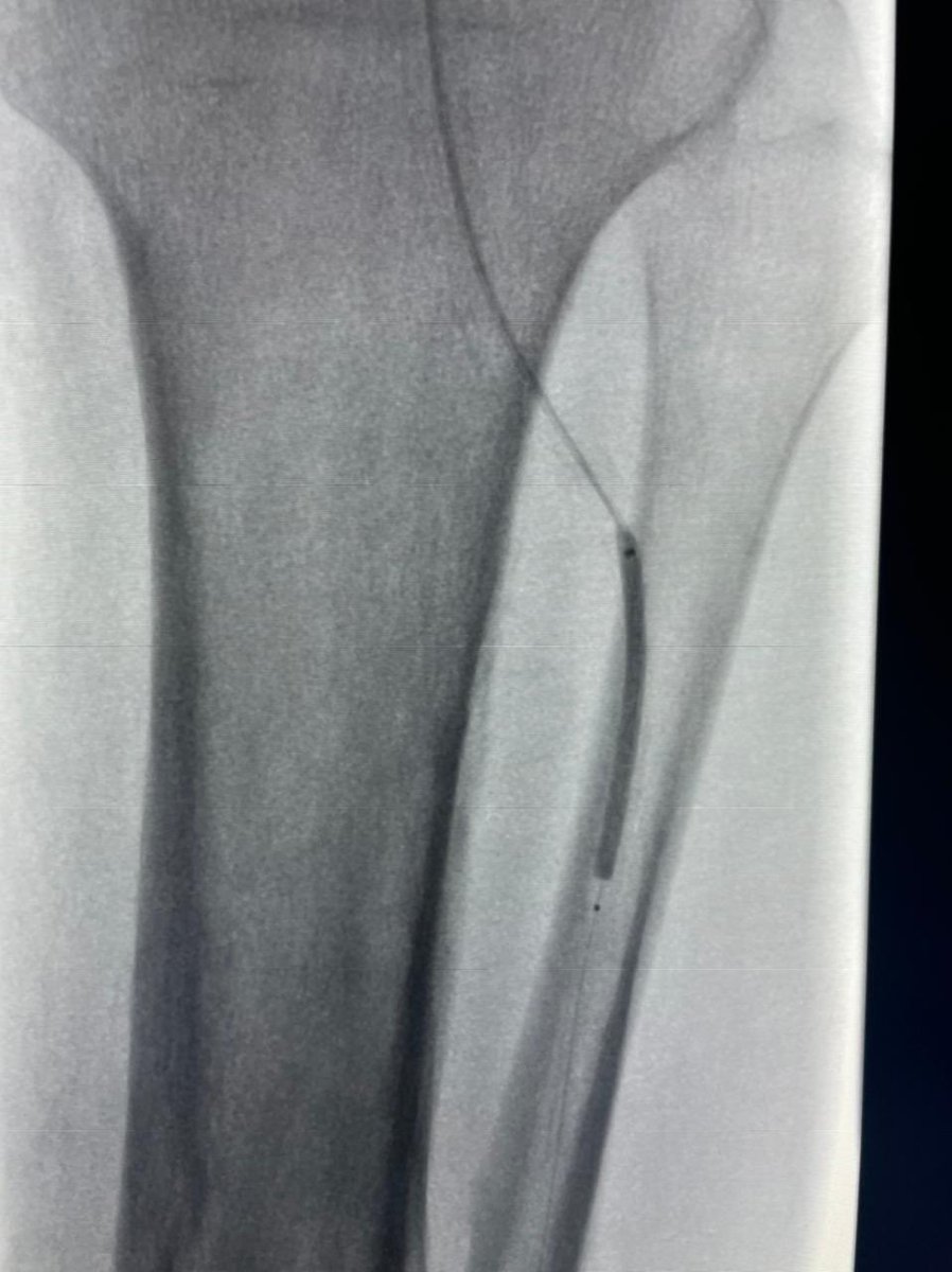 Adeebmsg's tweet image. توسيع تضيق شديد في شريان الساق الأمامي بنظام معالجة التكلسات داخل الأوعية الدموية والذي يحول الطاقة الكهربائية إلى طاقة ميكانيكية من خلال بالون منخفض الضغط يعتمد على الموجات بدون إصابة جدار الشرايين الطرفية.

#Shockwave angioplasty of the ATA
@ksmcmedia