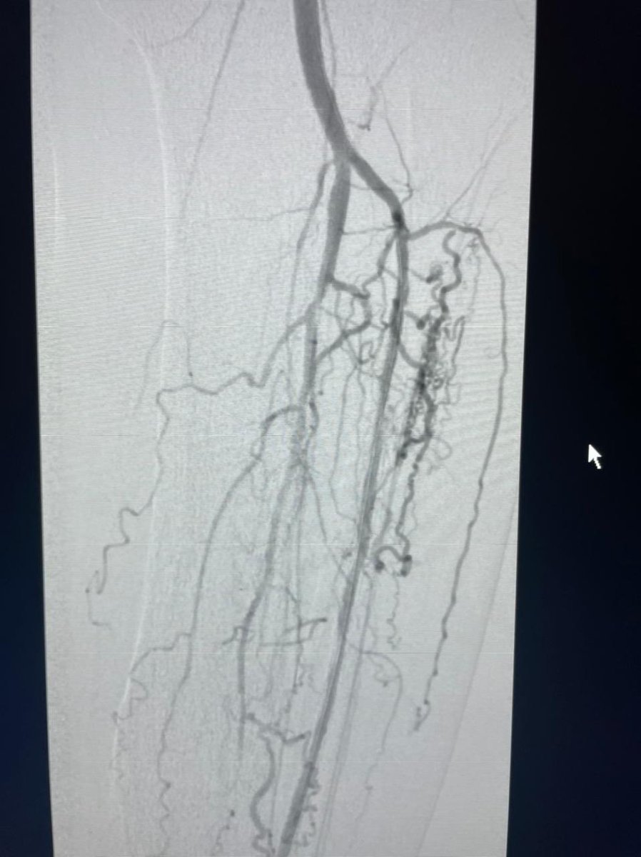 Adeebmsg's tweet image. توسيع تضيق شديد في شريان الساق الأمامي بنظام معالجة التكلسات داخل الأوعية الدموية والذي يحول الطاقة الكهربائية إلى طاقة ميكانيكية من خلال بالون منخفض الضغط يعتمد على الموجات بدون إصابة جدار الشرايين الطرفية.

#Shockwave angioplasty of the ATA
@ksmcmedia