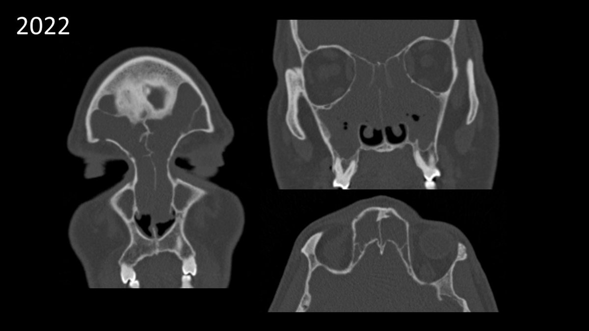 JohnCraigNose's tweet photo. Weekly #HFSNS promo case back at it! Never an ideal scenario here, but it's all good! Plenty of discussion on surgical vs medical options for nasal polyps on Fri 10/7 at #HFSNS. Register! (Recall: $20 tops!) @henryfordent #medtwitter https://t.co/P7bpjjzALr https://t.co/6MVyLFaQJY