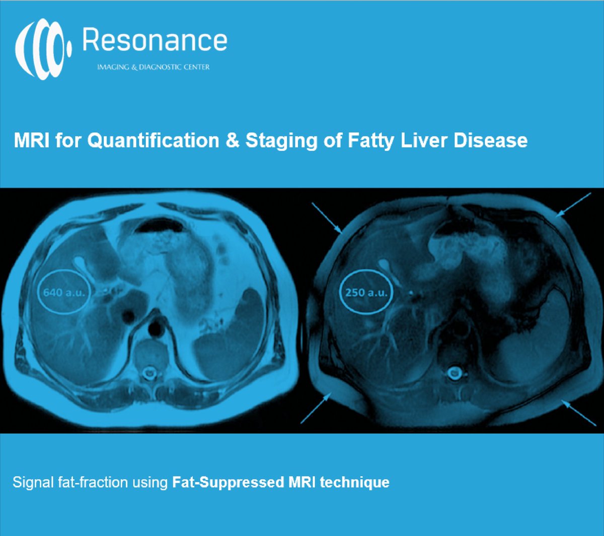 resonanceidc's tweet photo. MRI for #quantification & #staging of #fattyliverdisease is an attractive modality to assess #hepaticsteatosis. In & out of phase #MRI, calibrated with robust Liver/Fat standards have been found to be superior in quantifying #hepaticsteatosis, in comparison to #noninvasivemethods https://t.co/8i3AbEwfEd