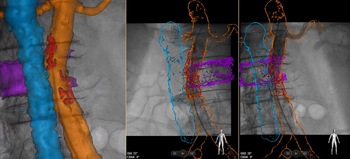El  acceso  transcava  es  una  opción  para  el  implante  de  TAVI....acceso difícil

👇👇👇👇👇😎😎😎👇👇👇👇

imagenretic.org/RevEcocarPract…

<a href="/MAecocardio/">MA Garcia Fernandez</a> <a href="/manuelbarreirop/">Manuel Barreiro-Perez</a> <a href="/almasthela/">Alma Sthela Arrioja, MD</a> <a href="/mariovar55/">Mario Vargas Galgani</a> <a href="/Azcarate_Cardio/">Doctor Pedro Azcárate</a> <a href="/josejgdnews/">Jose Juan Gomez</a> <a href="/javierurmeneta1/">Javier Urmeneta</a>