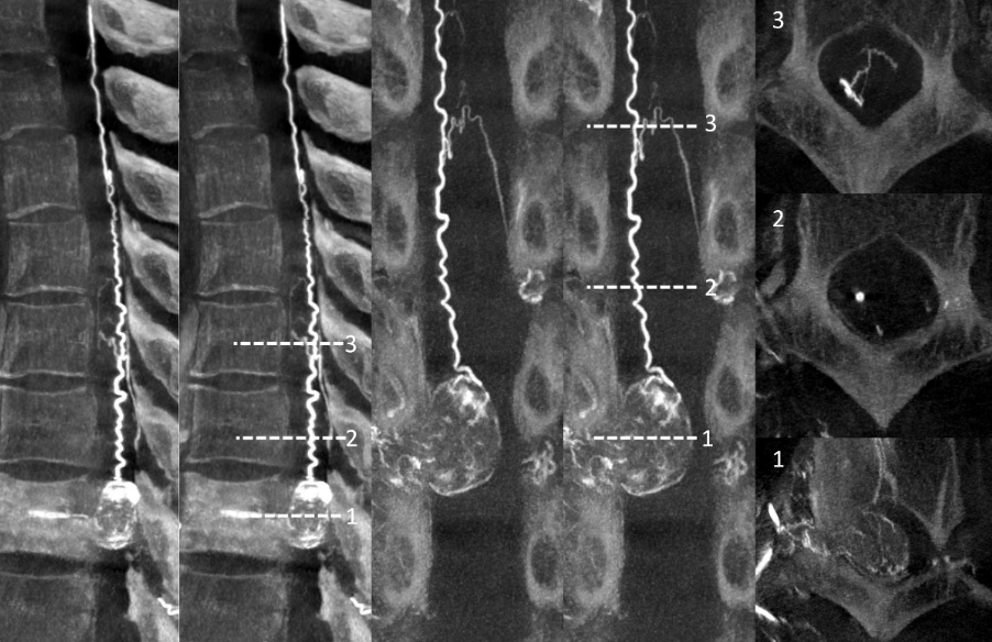 neuroangio1's tweet photo. Check this๐case of preoperative spinal angiogram for thoracic spinal lesion https://t.co/Cv5fb9BFyv Consistent use of #DynaCT #CBCTAngiography changed our practice @eytanraz @ENossek https://t.co/k14xzdHOWa
