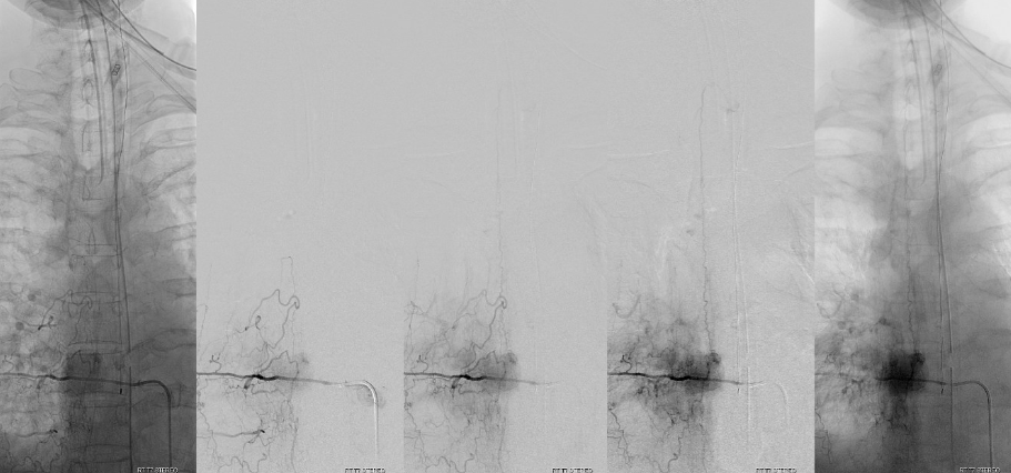 neuroangio1's tweet photo. Check this๐case of preoperative spinal angiogram for thoracic spinal lesion https://t.co/Cv5fb9BFyv Consistent use of #DynaCT #CBCTAngiography changed our practice @eytanraz @ENossek https://t.co/k14xzdHOWa