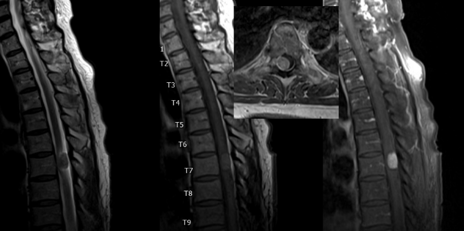 neuroangio1's tweet photo. Check this๐case of preoperative spinal angiogram for thoracic spinal lesion https://t.co/Cv5fb9BFyv Consistent use of #DynaCT #CBCTAngiography changed our practice @eytanraz @ENossek https://t.co/k14xzdHOWa