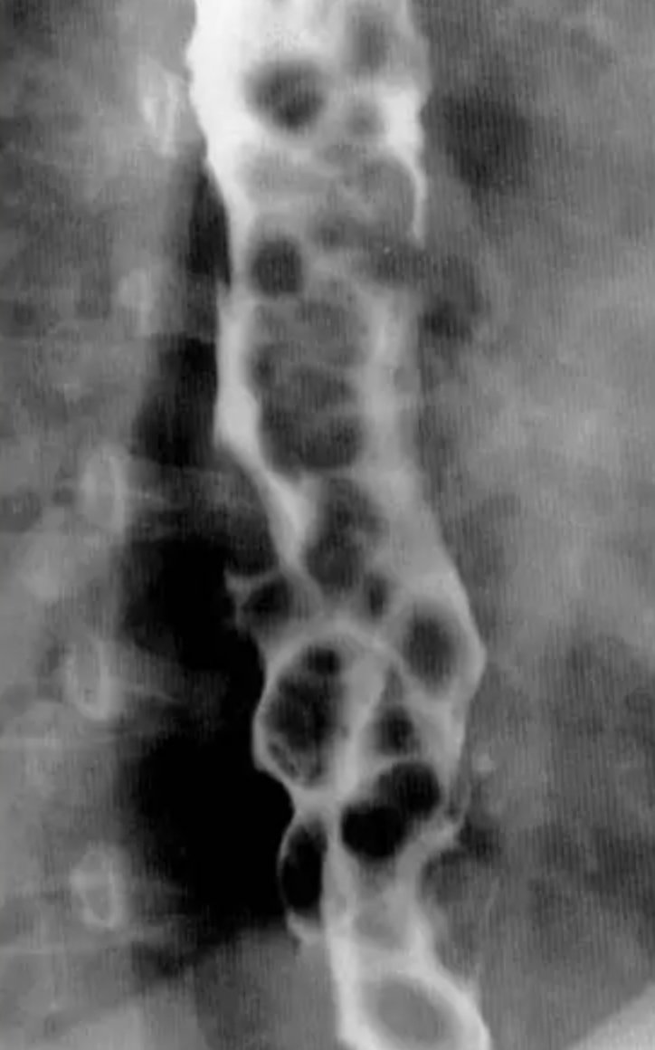 38M with difficulty swallowing. What is the diagnosis here? #radiology #meded #foamrad #radres #usmle #futureradres #medicine