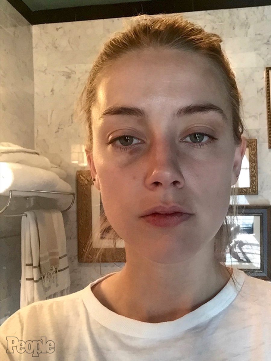“ShE hAd NO sWeLLinG!!!”

Her nose 
Jan 2012 vs Dec 2015