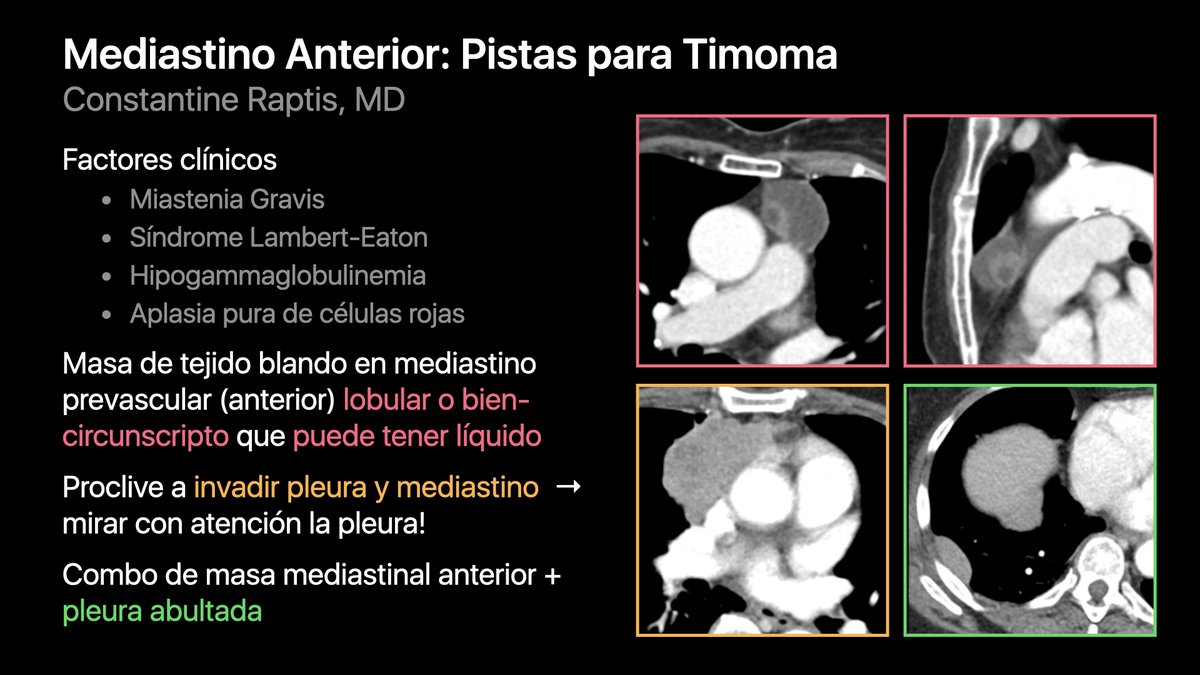 radiologiatorax's tweet photo. Dr. Constantine Raptis comparte su abordaje de las masas en mediastino anterior… (2/4) https://t.co/Txe6nzW5yN