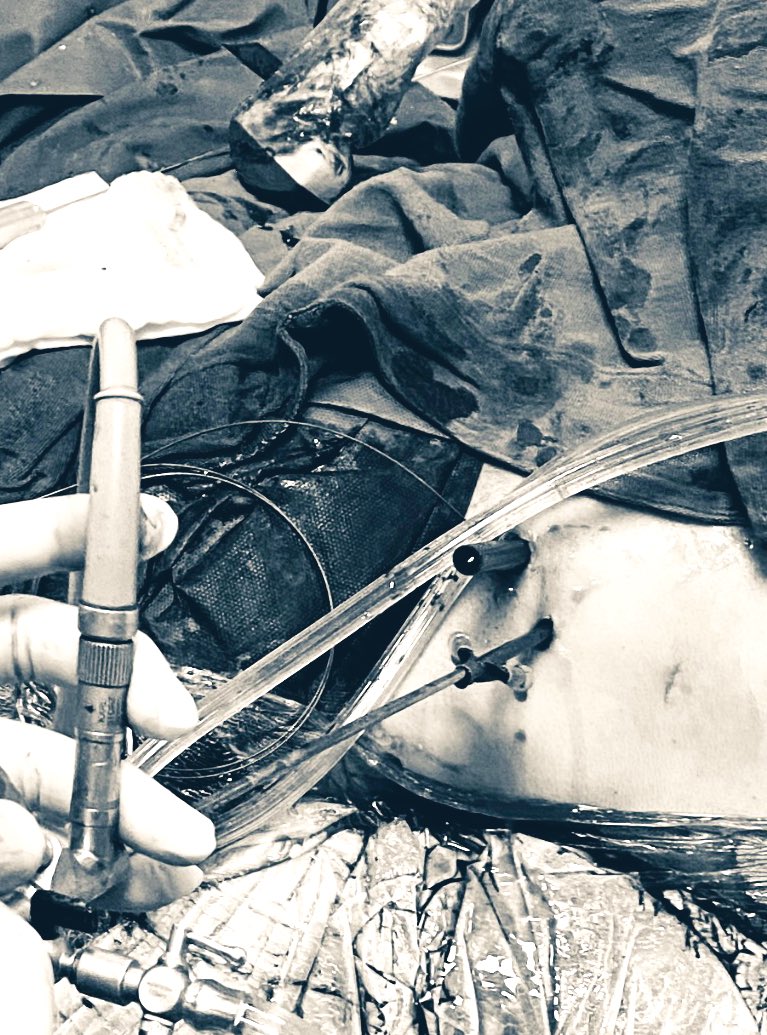 PulidoUro's tweet image. Nos quedamos sin ureteroscopio flexible. La opción para resolver lito en cáliz medio no accesible por tracto de cáliz inferior fue: 

Un mini tracto 14Fr con camisa seplou peel-away y litotricia laser. 
@Urologia_UMAET1 @MAGarciaPadilla @UroMedrano 
 #XrayFree #ultrasound_guided