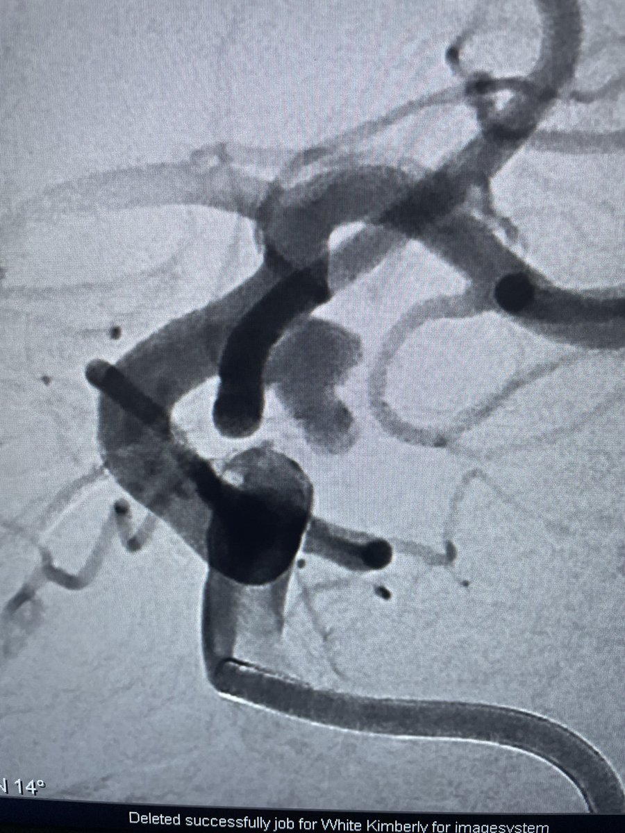 alex_spiotta's tweet photo. September is brain aneurysm awareness month: if you have risk factors like a strong family history get screened !  here is an example of a ruptured bilobed aneurysm treated with coil embolization ⁦@BAFOUND⁩ ⁦@HolyCityNsgy⁩ ⁦@MUSChealth⁩ https://t.co/4IviqUyVzB