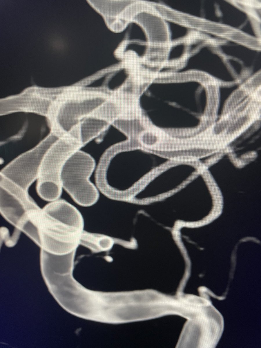 alex_spiotta's tweet photo. September is brain aneurysm awareness month: if you have risk factors like a strong family history get screened !  here is an example of a ruptured bilobed aneurysm treated with coil embolization ⁦@BAFOUND⁩ ⁦@HolyCityNsgy⁩ ⁦@MUSChealth⁩ https://t.co/4IviqUyVzB