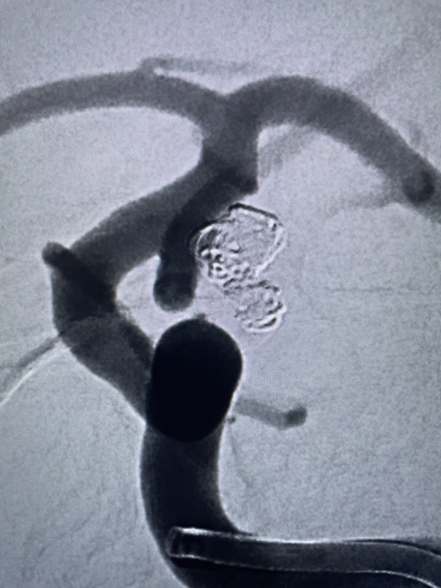alex_spiotta's tweet photo. September is brain aneurysm awareness month: if you have risk factors like a strong family history get screened !  here is an example of a ruptured bilobed aneurysm treated with coil embolization ⁦@BAFOUND⁩ ⁦@HolyCityNsgy⁩ ⁦@MUSChealth⁩ https://t.co/4IviqUyVzB