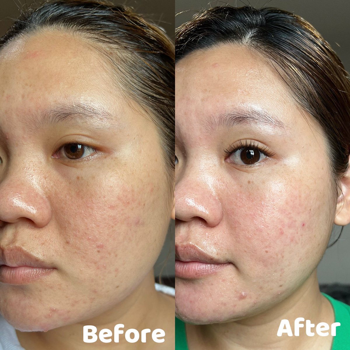 สกินแคร์ #BTFarmskin น้องใหม่จากเกาหลีเริ่ดมากทุกคน ตัวแรกคือ #โทนเนอร์น้ำตบแตงโม ตัวนี้เราเทใส่สำลีเช็คทั่วหน้า ปรับสภาพผิวก่อนลงครีม ตัวที่2คือ #อิมัลชั่นแต่งโม เนื้อเกลี่ยง่าย ช่วยเพิ่มความชุ่มชื่น ใช้คู่กันคือเห็นผลดีมาก ผิวอิ่มน้ำ หน้ามันน้อยลง ของมันต้องมี #ใช้ดีบอกต่อ