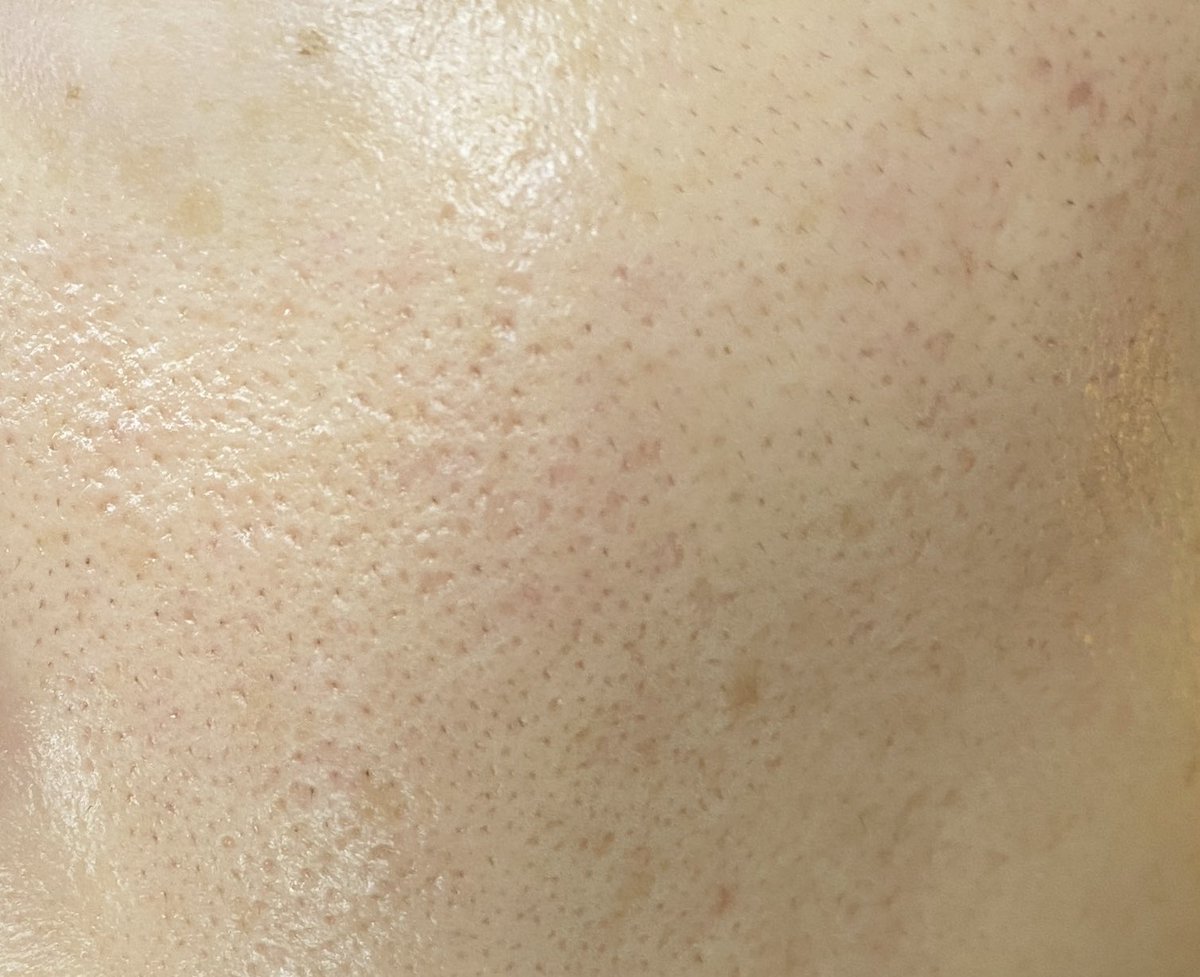 ichi_beauty's tweet photo. 美容に数百、数千万お金を掛けきて毛穴一つない彼女から言われた絶対すべき4つの行動。

①脱毛
②ポテンツァorピコフラクショナルで肌を滑らかに(ニキビ跡)
③ピコトーニングでシミ消しトーンアップ(月1)
④毎晩レチノール塗る

どちらもiPhone外カメ撮影。前に比べまじで肌綺麗になってきた🥲 https://t.co/9Di7Evv4Yl