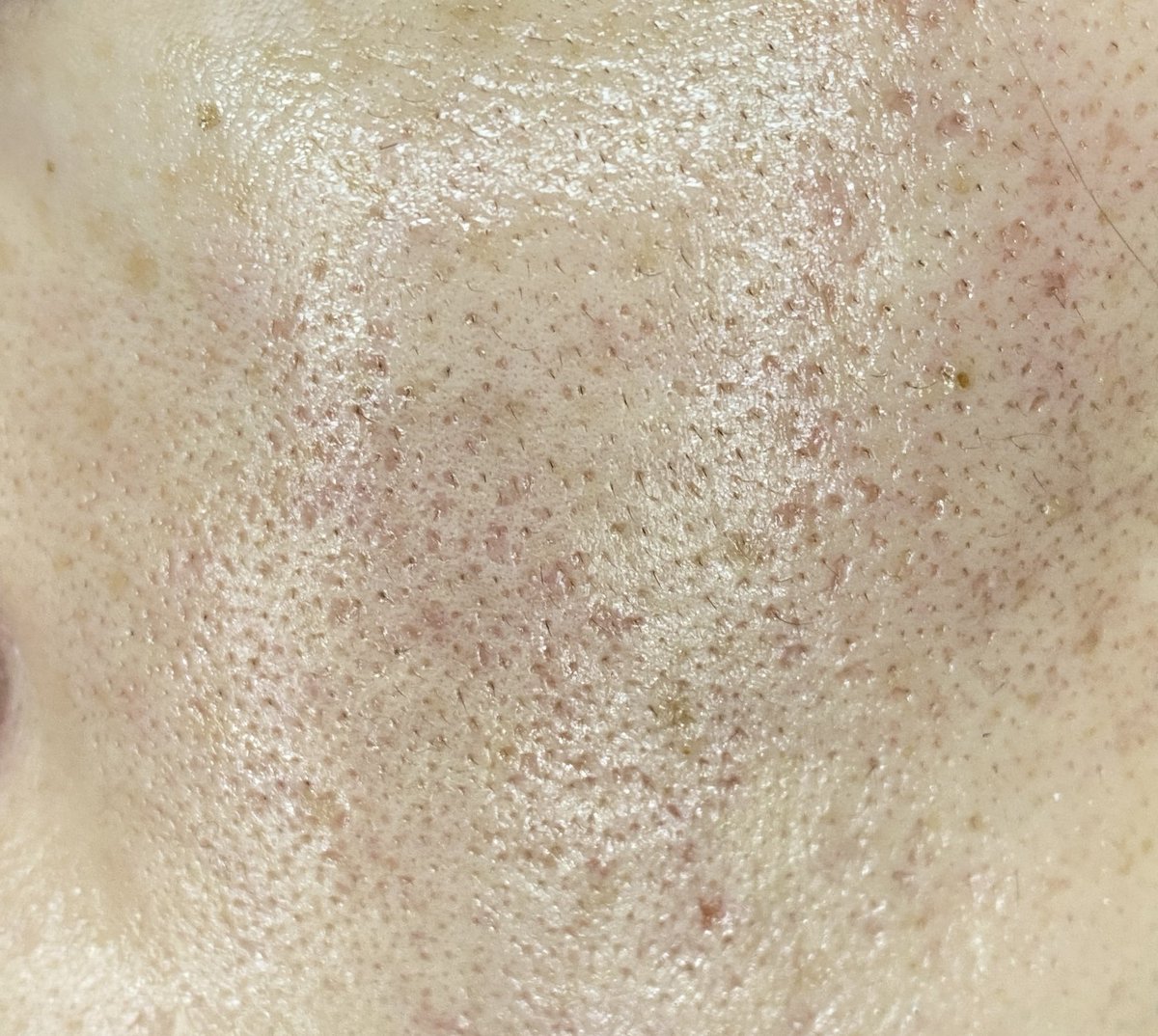 ichi_beauty's tweet photo. 美容に数百、数千万お金を掛けきて毛穴一つない彼女から言われた絶対すべき4つの行動。

①脱毛
②ポテンツァorピコフラクショナルで肌を滑らかに(ニキビ跡)
③ピコトーニングでシミ消しトーンアップ(月1)
④毎晩レチノール塗る

どちらもiPhone外カメ撮影。前に比べまじで肌綺麗になってきた🥲 https://t.co/9Di7Evv4Yl