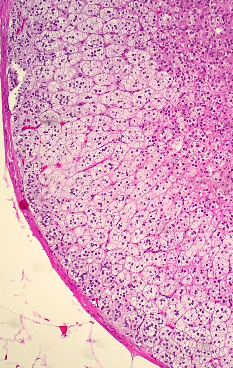 Adrenal rest in a fallopian tube #beautyinthebenign #everydayGYN #Gynpath #pathology #PathResident #pathfellow