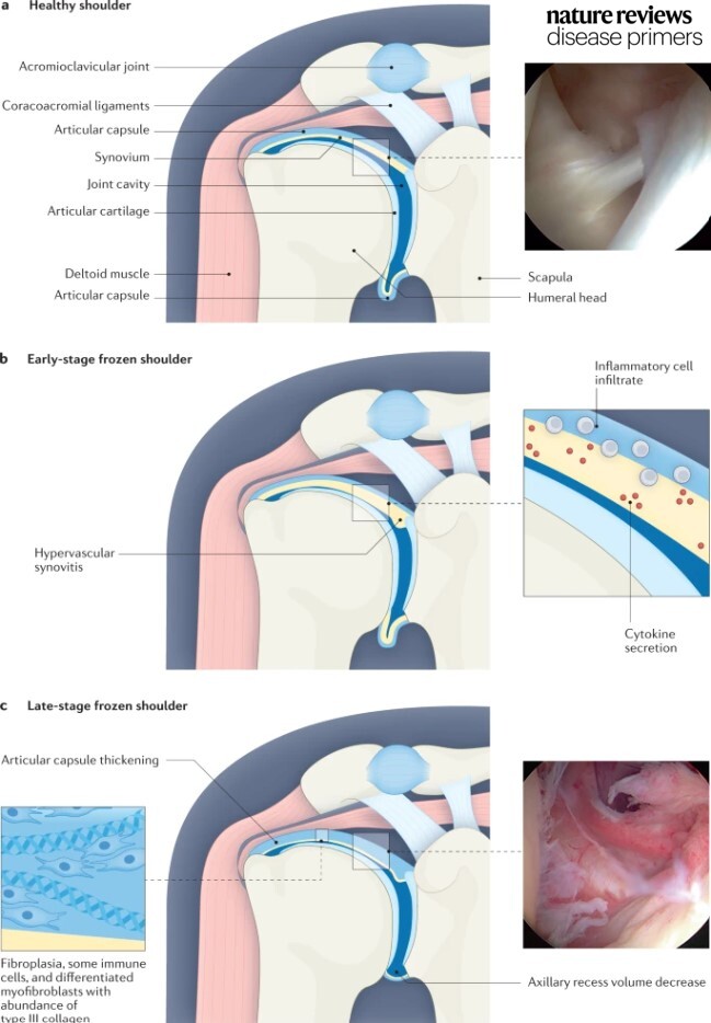 In #frozenshoulder, there is fibrosis and thickening of the connective tissue membrane as well as the adjacent synovial membrane. 

go.nature.com/3qiWbIP