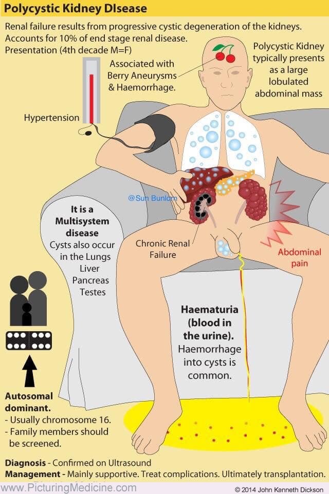 Polycystic kidney disease #Bjhm #MedEd #FOAMed #Medtwitter #Nephpearls #medstudenttwitter