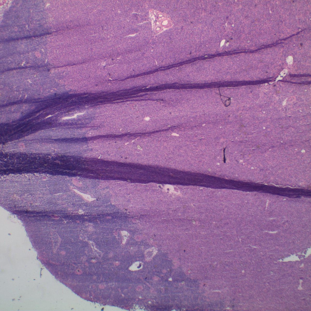 EKoubaMD's tweet photo. Sentinel lymph node with metastatic carcinoma and foreign body giant cells (history of prior implants); Frozen section two-fer #breastpath #frozenpath #pathtwitter https://t.co/NPRAphzyjR