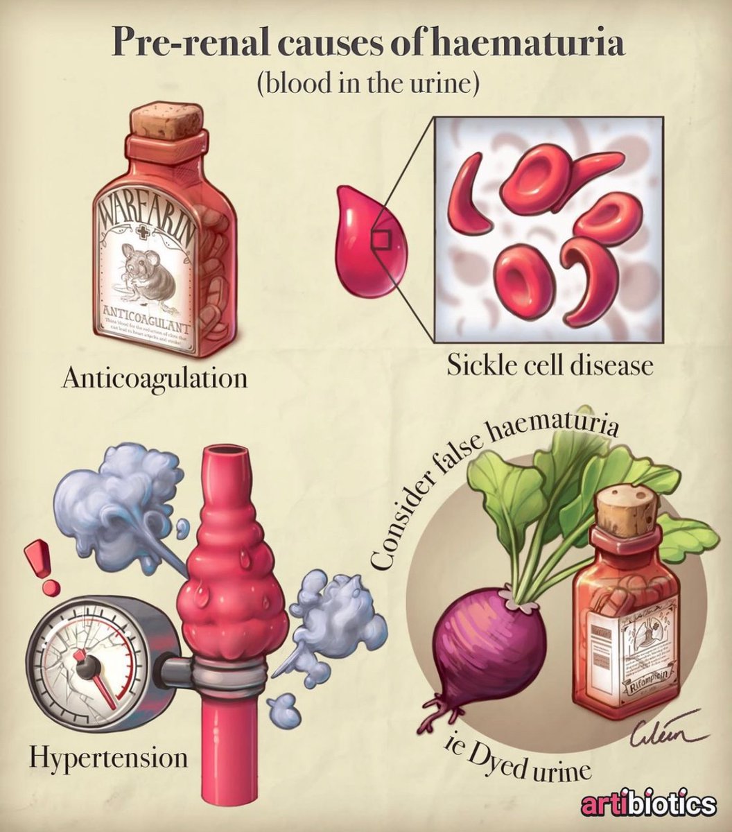 <a href="/artibiotics/">Ciléin Kearns</a> Pre-renal causes of hematuria #Medstudents