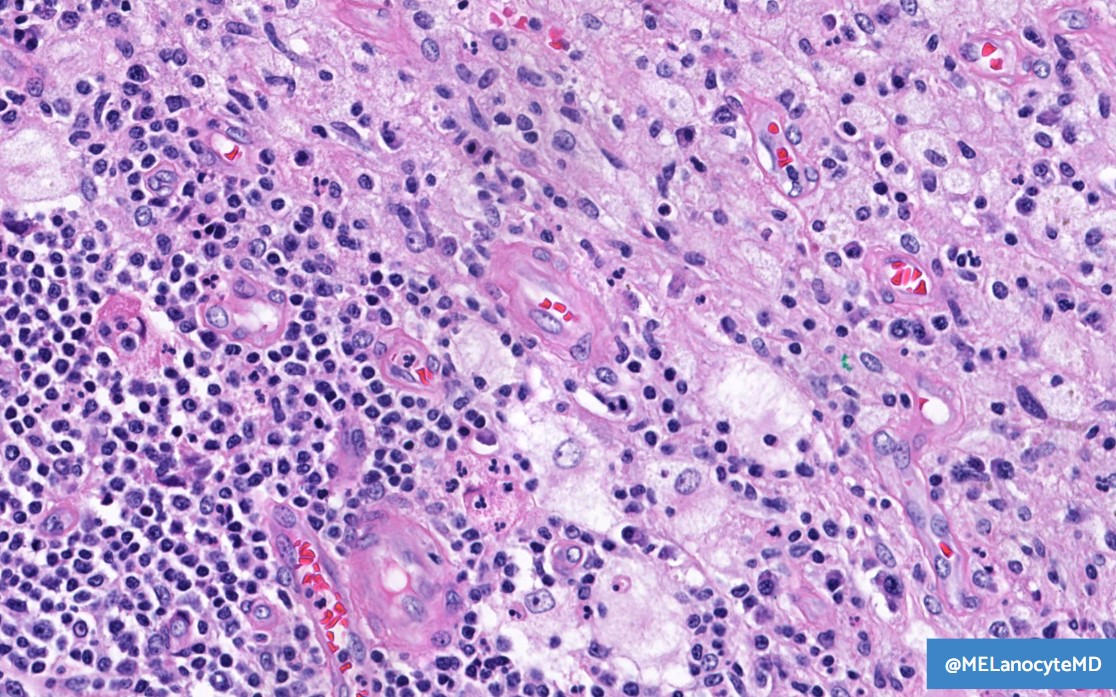 MELanocyteMD's tweet photo. 59♀️ w/ foot mass

➡️ Differential diagnosis?
➡️ What confirmatory IHC could you order?

🔬 WSI: https://t.co/hS1Mk58dh3
💡 Answer: https://t.co/dlTorqSiUZ

#bstpath #dermpath #kiko25 https://t.co/N1jlmxuaoC