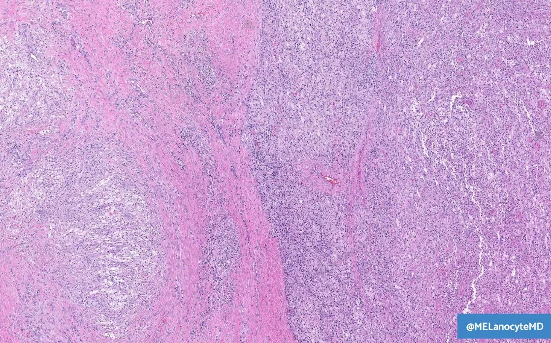 MELanocyteMD's tweet photo. 59♀️ w/ foot mass

➡️ Differential diagnosis?
➡️ What confirmatory IHC could you order?

🔬 WSI: https://t.co/hS1Mk58dh3
💡 Answer: https://t.co/dlTorqSiUZ

#bstpath #dermpath #kiko25 https://t.co/N1jlmxuaoC