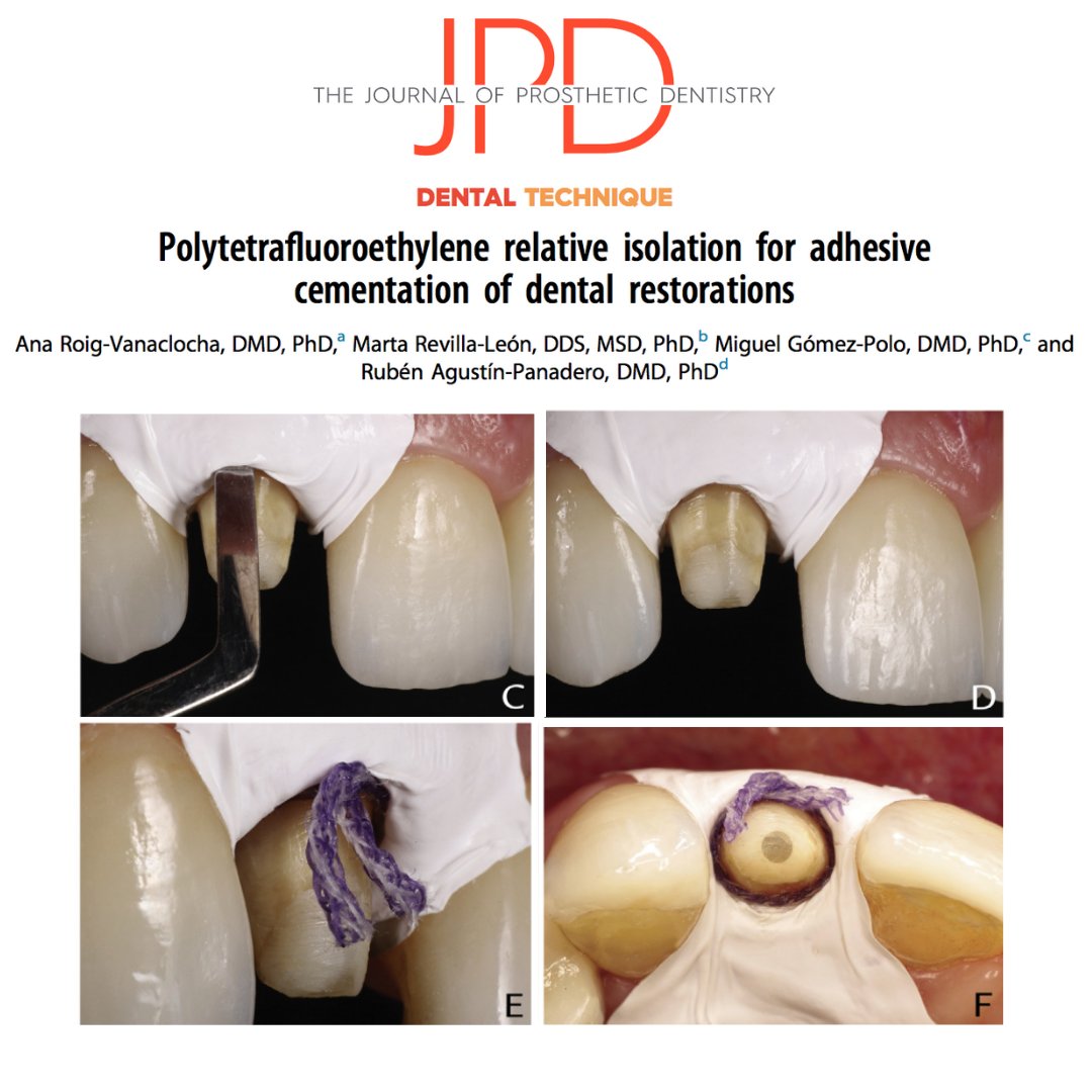 JPDentistry's tweet photo. This #dentaltechnique article shows how to achieve isolation by using #polytetrafluoroethylene tape to prepare for #tooth #adhesivecementation. Learn more: https://t.co/BC8lXjrNmX https://t.co/KaooTPxPHF