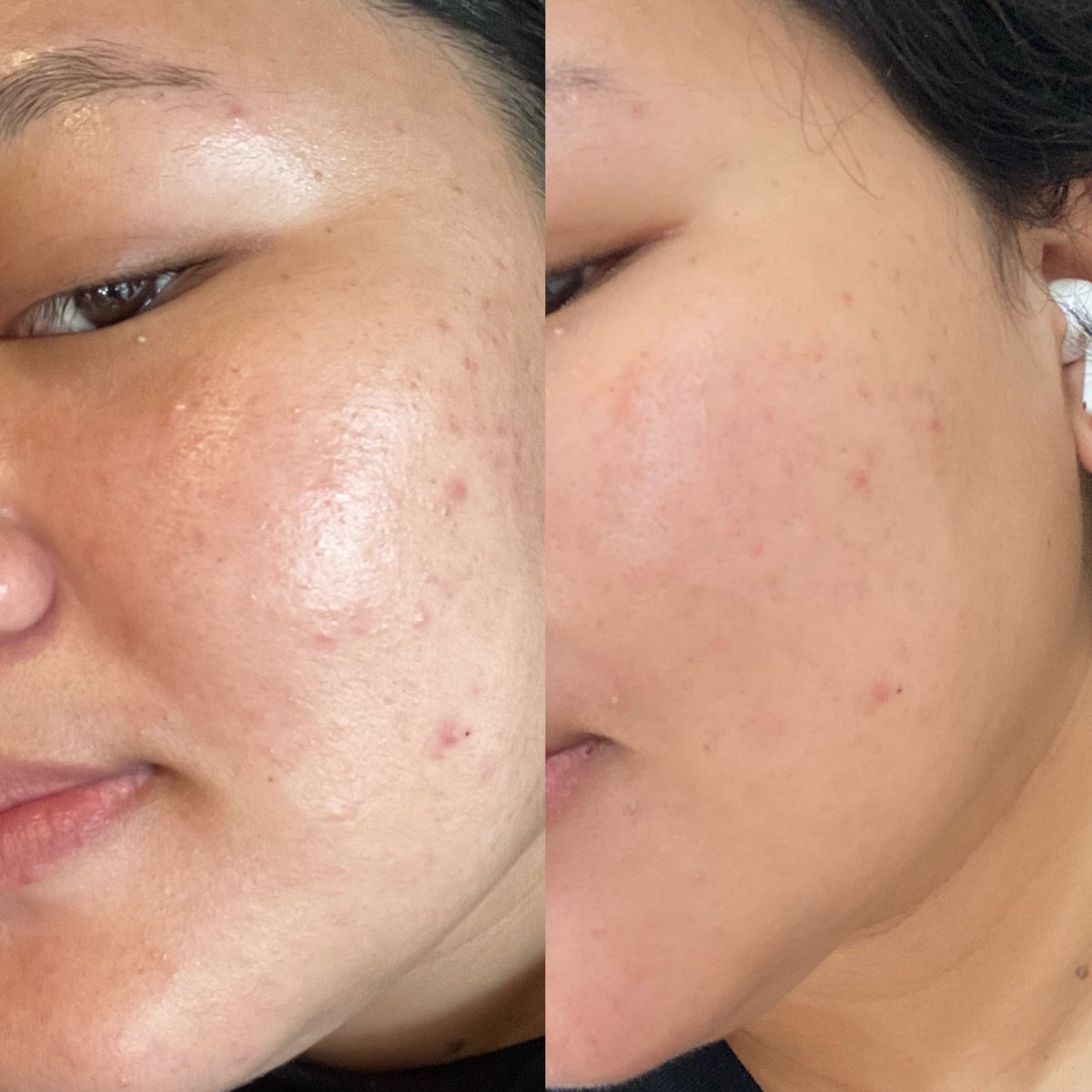 Kayy 🌸 on Twitter "RT sukaskincarean Tips pakai face oil buat pertama kali yang pakai face