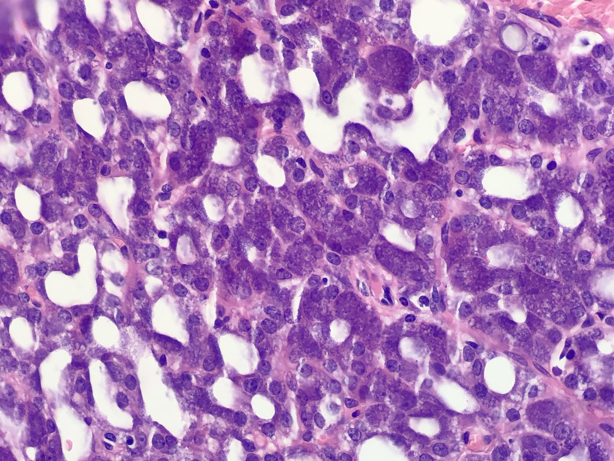 FelipePatologia's tweet photo. Parotid mass.
What is the diagnosis and the IHC marker? https://t.co/OesmTr0gB5