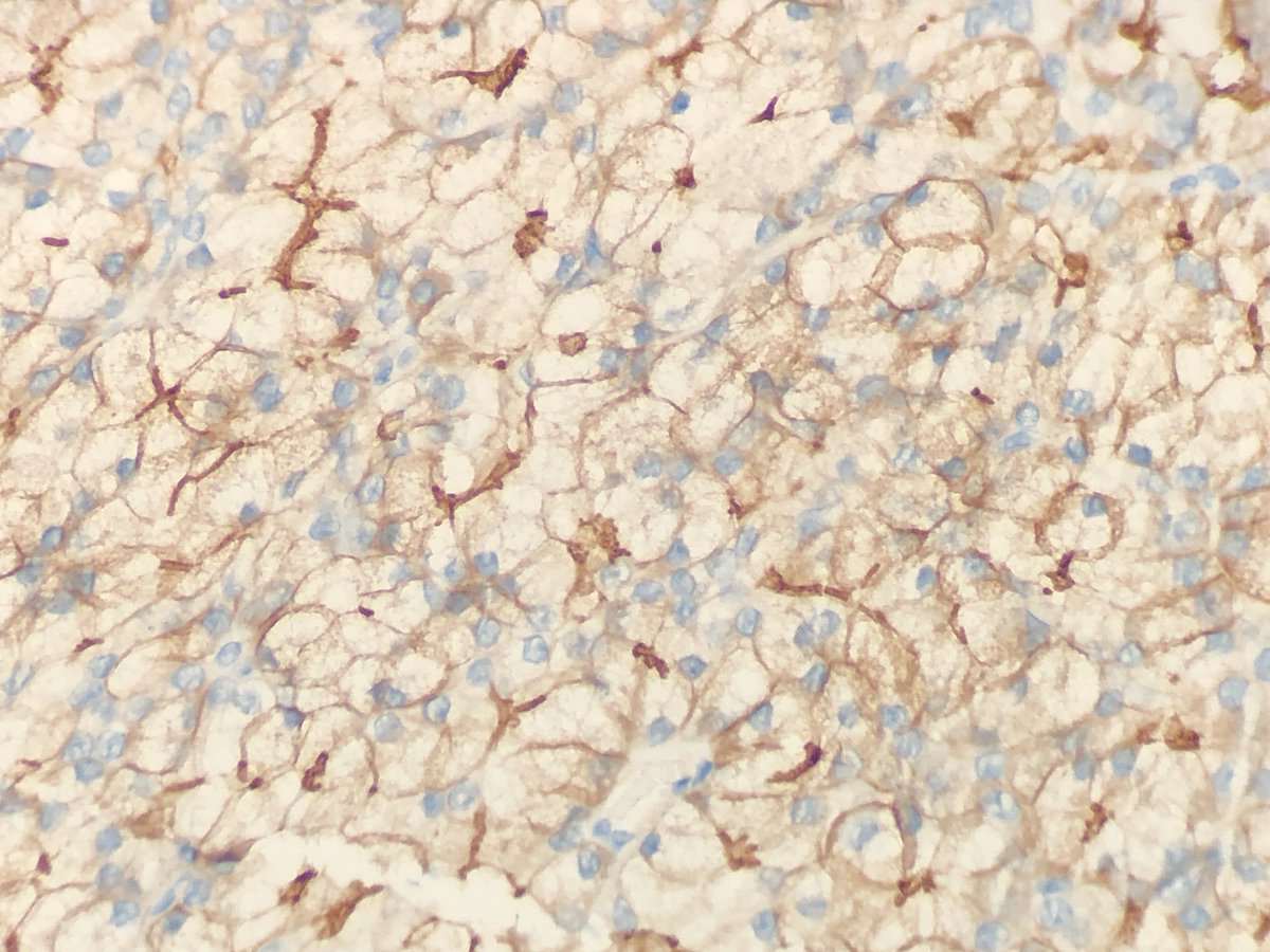 FelipePatologia's tweet photo. Parotid mass.
What is the diagnosis and the IHC marker? https://t.co/OesmTr0gB5