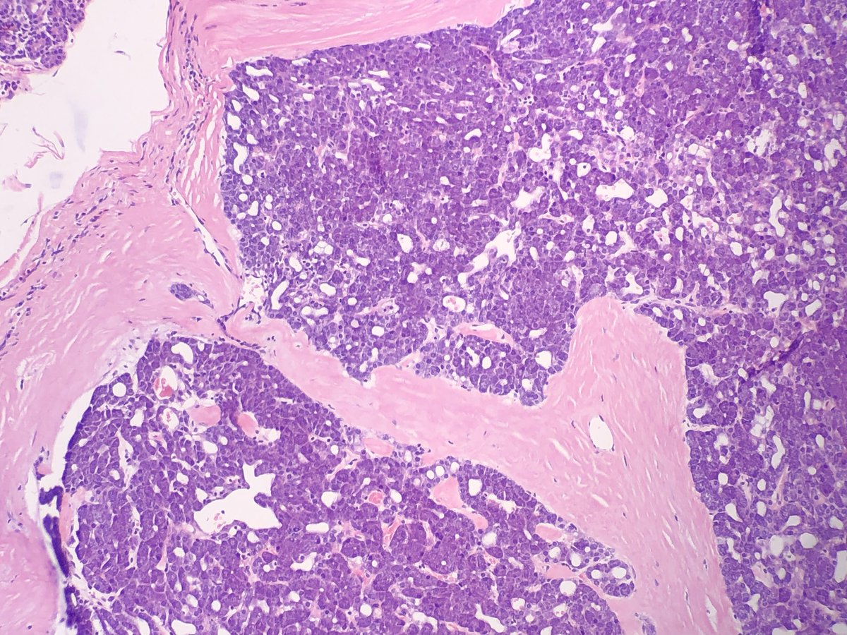 FelipePatologia's tweet photo. Parotid mass.
What is the diagnosis and the IHC marker? https://t.co/OesmTr0gB5