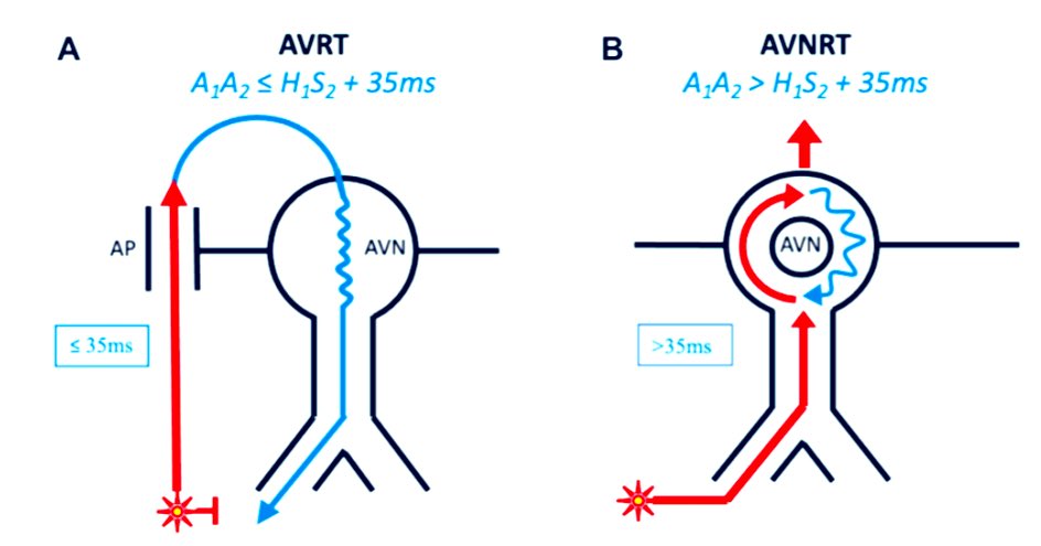 Brock Gambill (@forkknifecab_ep) on Twitter photo Applying this new maneuver published <a href="/hrs_journal/">HeartRhythm</a>. A properly fused “HrPVC” showed nodal response in presence of left posterior AP. A study designed ErPVC correctly confirmed an extra-nodal response. Portland Mappers Anonymous current maneuver competition. #PDXMapping <a href="/bmetzlerEP/">Brittany Metzler</a> Applying this new maneuver published <a href="/hrs_journal/">HeartRhythm</a>. A properly fused “HrPVC” showed nodal response in presence of left posterior AP. A study designed ErPVC correctly confirmed an extra-nodal response. Portland Mappers Anonymous current maneuver competition. #PDXMapping <a href="/bmetzlerEP/">Brittany Metzler</a>