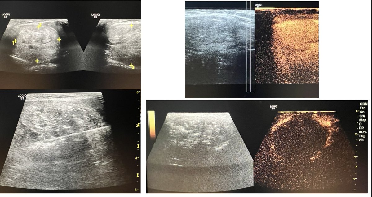Dr Ajit Yadav (@drajityadav) on Twitter photo Today successfully did Workshop on “THYROID NODULE MWA” at Sir Gangaram Hospital Delhi
2 live cases of thyroid nodule
15 Participants from all over the India
<a href="/ISVIRIndia/">ISVIR India</a> <a href="/jcir_journal/">JCIR_Journal</a> <a href="/drgauravgangwni/">Dr. Gaurav Gangwani (Interventional Radiologist)</a> <a href="/keithppereira/">Keith Pereira MD, #VIrad</a> <a href="/RajNarayanan67/">Raj Narayanan</a> <a href="/pairsmedia/">PAIRS</a> <a href="/No_cut_surgery/">IIR IRad indore</a> <a href="/iRadRock/">𝙍𝙖𝙠𝙚𝙨𝙝 𝙎. 𝘼𝙝𝙪𝙟𝙖, 𝙈𝘿</a> Today successfully did Workshop on “THYROID NODULE MWA” at Sir Gangaram Hospital Delhi
2 live cases of thyroid nodule
15 Participants from all over the India
<a href="/ISVIRIndia/">ISVIR India</a> <a href="/jcir_journal/">JCIR_Journal</a> <a href="/drgauravgangwni/">Dr. Gaurav Gangwani (Interventional Radiologist)</a> <a href="/keithppereira/">Keith Pereira MD, #VIrad</a> <a href="/RajNarayanan67/">Raj Narayanan</a> <a href="/pairsmedia/">PAIRS</a> <a href="/No_cut_surgery/">IIR IRad indore</a> <a href="/iRadRock/">𝙍𝙖𝙠𝙚𝙨𝙝 𝙎. 𝘼𝙝𝙪𝙟𝙖, 𝙈𝘿</a>