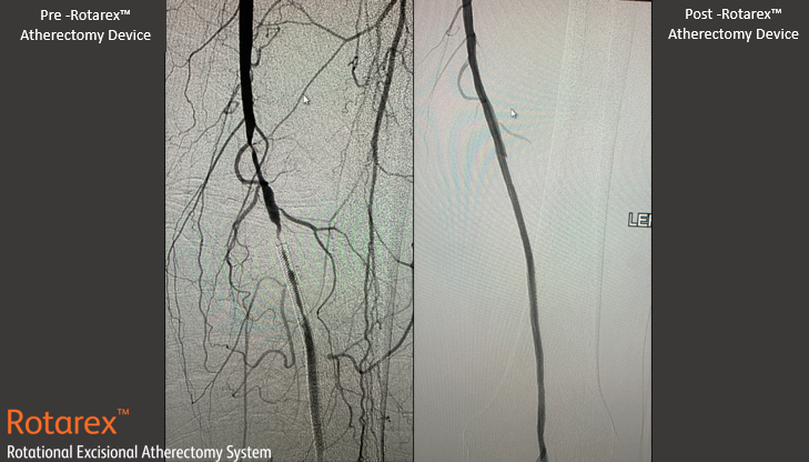 TimHugBD's tweet photo. Peripheral artery in-stent restenosis case by Dr. Daniels- great result! 
#RemoveWithRotarex
Not for use in the cardiopulmonary, coronary, carotid, cerebral, renal or venous vasculature. Safety info: https://t.co/C9wGaDZAdo https://t.co/9pBlDlJnlp