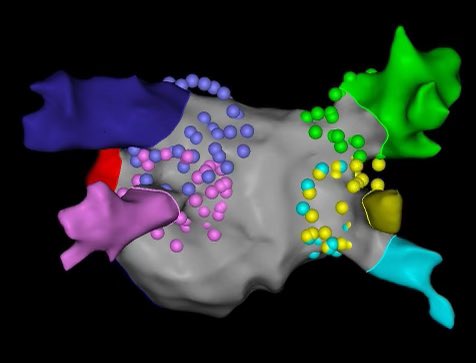 Marvin Lu (@marvlu) on Twitter photo Its a privilege to be training <a href="/emoryheart/">Emory Cardiology</a> with <a href="/DavidBDeLurgio/">David DeLurgio</a> to experience PFA firsthand. #EPeeps #varipulse #AdmIREtrial @BiosenseWebster Its a privilege to be training <a href="/emoryheart/">Emory Cardiology</a> with <a href="/DavidBDeLurgio/">David DeLurgio</a> to experience PFA firsthand. #EPeeps #varipulse #AdmIREtrial @BiosenseWebster