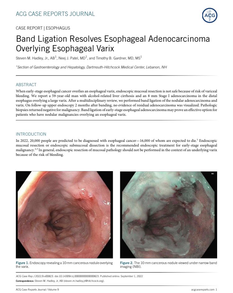 ebtapper's tweet photo. Round of applause for the newest member of the EGD Hall of Fame:

1️⃣biopsied a lesion over a large varix. It was esophageal cancer
2️⃣banded the cancer/varix, curing cancer and treating the varix

https://t.co/yP6D1TRDc6 #cirrhosis #livertwitter https://t.co/wqPcYJVMQC