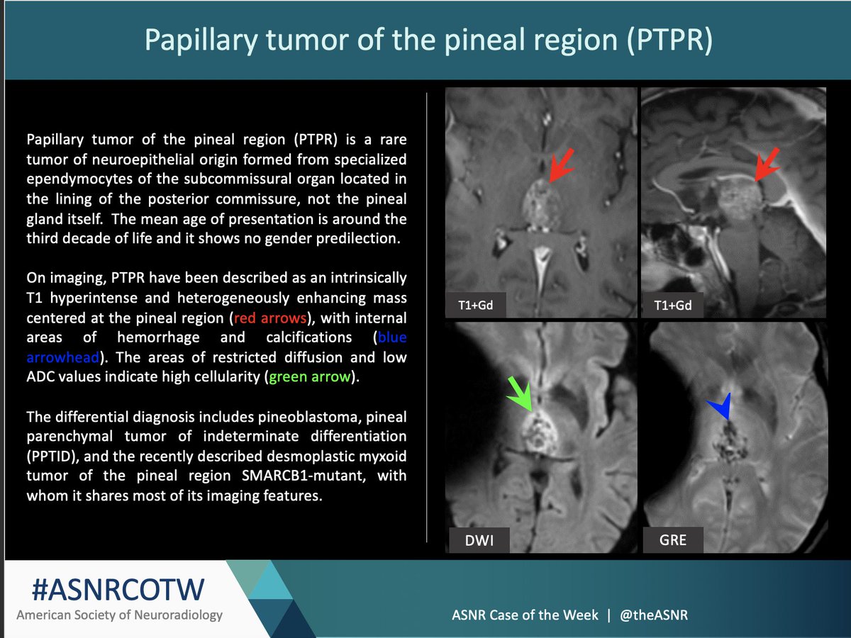 TheASNR's tweet photo. Great job everyone! This is a papillary tumor of the pineal region https://t.co/kidl0UgaWO