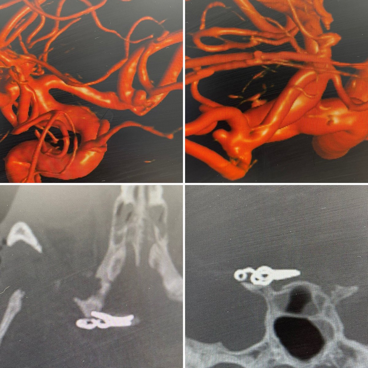 graffeo's tweet photo. Week 4 @OU_Neurosurgery was a real 🌪... first 🖇🎈 as a staff, tons of #complexcranial cases, a talk on #farlateral #neuroanatomy, & most importantly, honored to be named our first Medical Student Director! So pumped to serve & teach in this new role @OUCollegeofMed 😷🔪💀🧠👨🏫 https://t.co/UvRWStS8z6